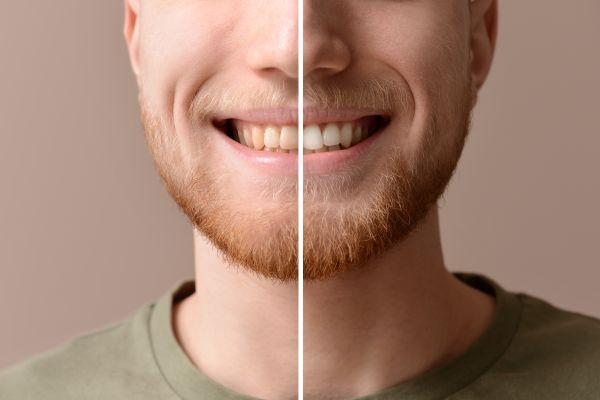 Before and after comparison of teeth whitening results using Opalescence Home kits at West Augusta Dental Associates